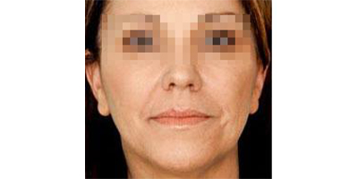 玻尿酸去面部細(xì)紋術(shù)前