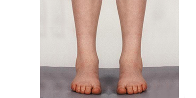 長短腿矯正術(shù)后