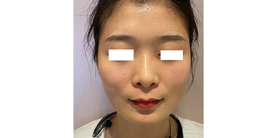 玻尿酸豐太陽穴術后