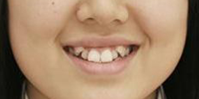 隱形托槽矯正術(shù)前