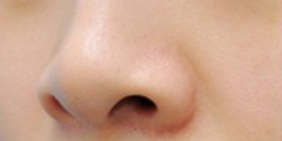 注射縮鼻頭術(shù)前