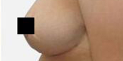 乳房下垂矯正術(shù)后