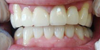 舌側(cè)矯正術(shù)后