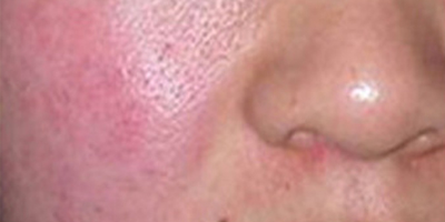 射頻微針術(shù)前