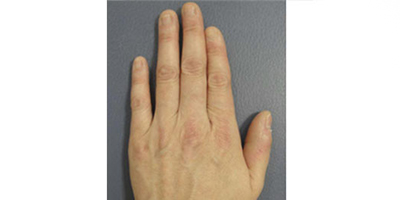 自體脂肪豐手術(shù)前