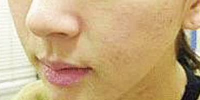 抗敏修復(fù)術(shù)后