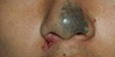 激光去胎記術(shù)前