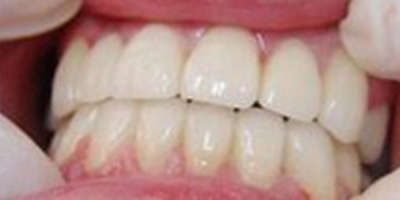 二氧化鋯全瓷牙術(shù)后