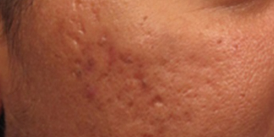 離子束激光術(shù)前