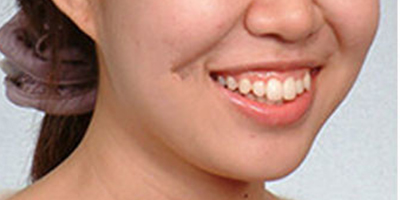 注射去露齦笑術(shù)前