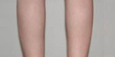 注射瘦小腿術(shù)后