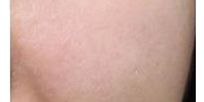 玻尿酸導(dǎo)入術(shù)后