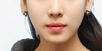 注射瘦臉術(shù)后