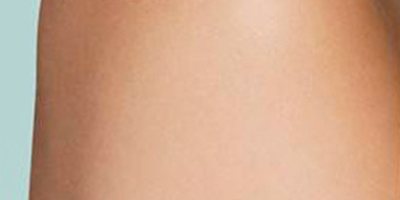 激光去紋身術后