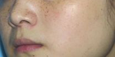 生美祛斑術(shù)前