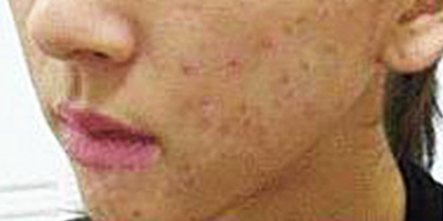 抗敏修復(fù)術(shù)前