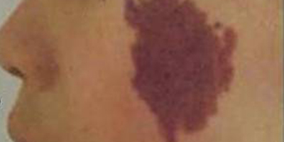 手術去胎記術前