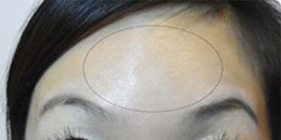 注射去動態(tài)紋術后