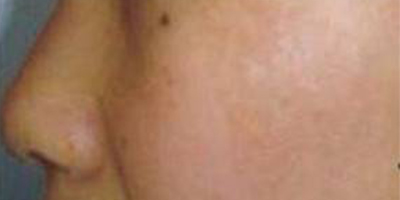 手術去胎記術后