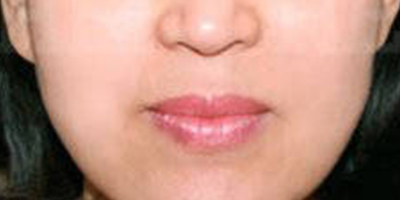 按摩緊致術(shù)后