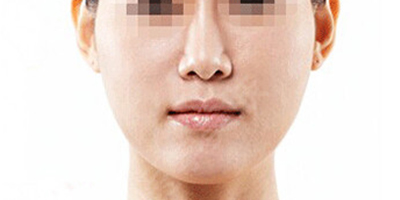 注射去法令紋術(shù)后