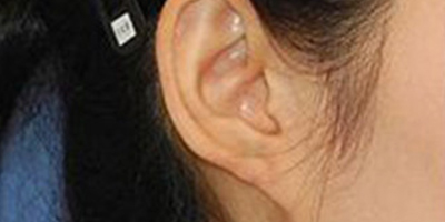 自體脂肪豐耳垂術(shù)后