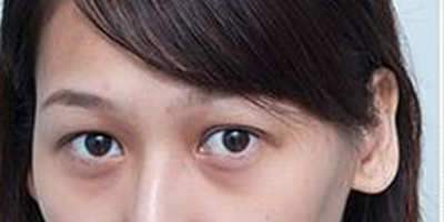 自體脂肪豐淚溝術前