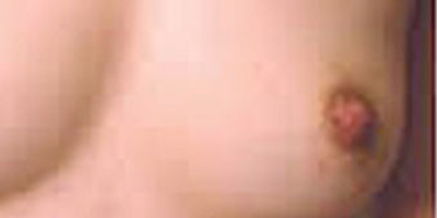 乳頭內(nèi)陷矯正術(shù)后