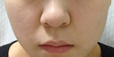 白瓷娃娃術(shù)前