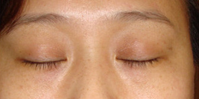 洗眼線術(shù)后