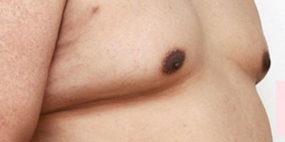 男性乳房肥大矯正術(shù)前