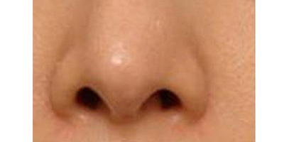 鼻部膨體假體取出術(shù)前