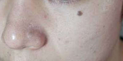 激光點痣術(shù)前