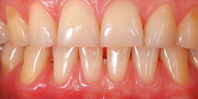 牙齦炎術(shù)后