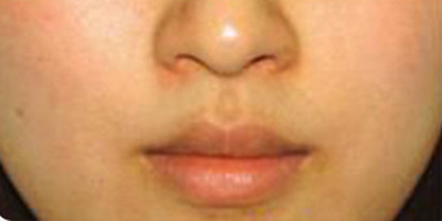 水氧活膚術(shù)前