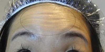 注射去動態(tài)紋術前