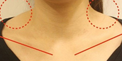 注射瘦肩肌術(shù)前