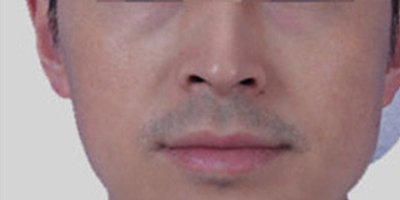 M22王者之冠術(shù)后