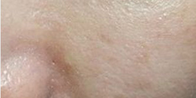 皮膚檢測術(shù)前