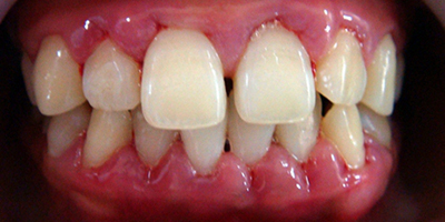 牙齦炎術(shù)前