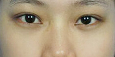 E光嫩膚術(shù)后