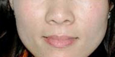 激光祛斑術(shù)后