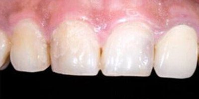 瓷貼面術(shù)前