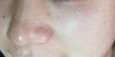 激光點痣術(shù)后