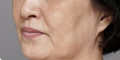 青春解碼儀美膚術(shù)前