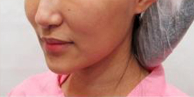 下巴硅膠假體取出術(shù)前