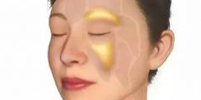 自體脂肪存儲(chǔ)術(shù)后