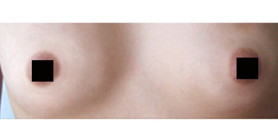 乳暈縮小術(shù)后