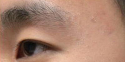 杏仁酸煥膚術(shù)后