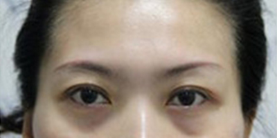 自體脂肪豐太陽(yáng)穴術(shù)前